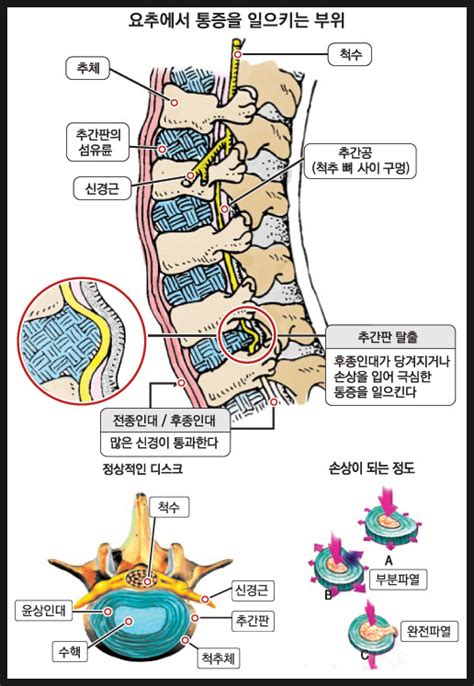 척추 디스크 구조